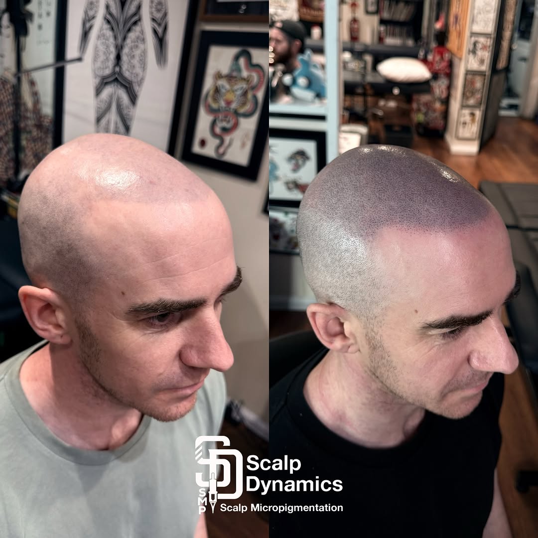 Recent Scalp Dynamics treatment 12
